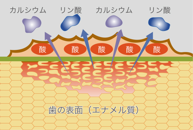 脱灰（むし歯になりやすい状態）
