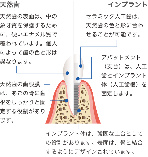 インプラント治療とは