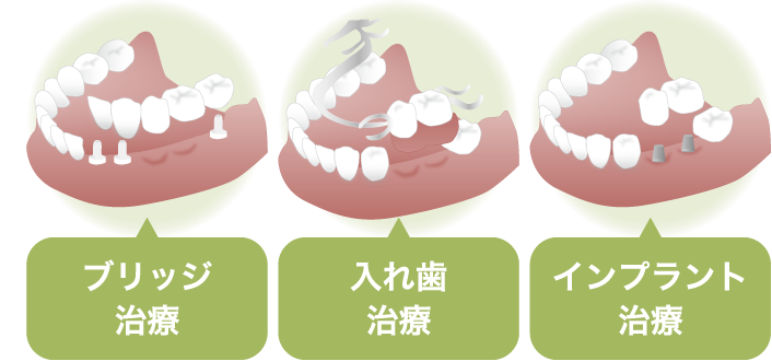 他の治療と比較したインプラント治療のメリット