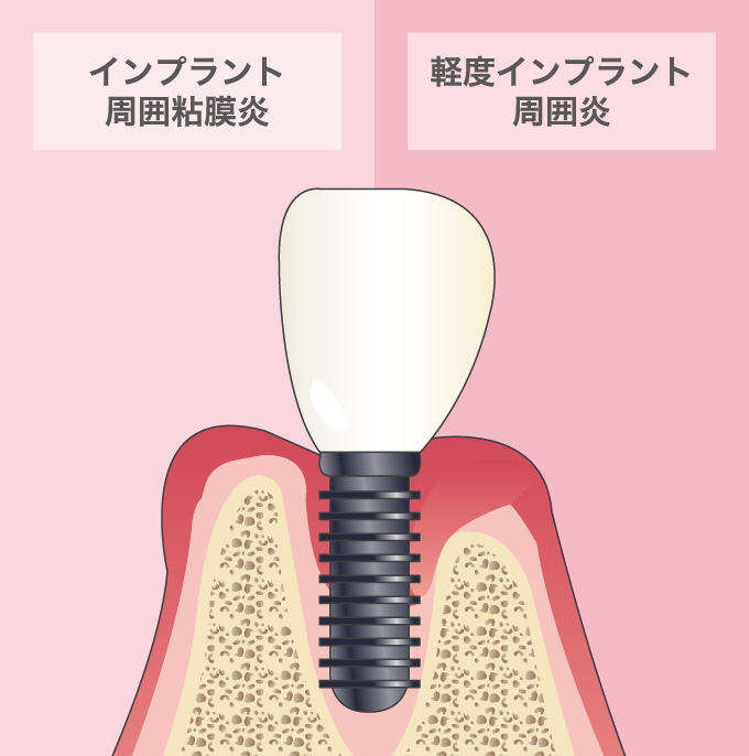 インプラント周囲粘膜炎、軽度インプラント周囲炎