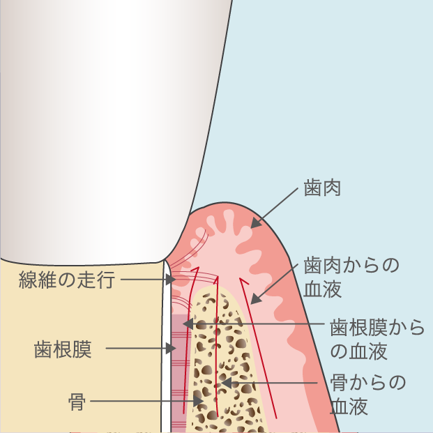 「インプラント周囲炎」が発症するリスク
