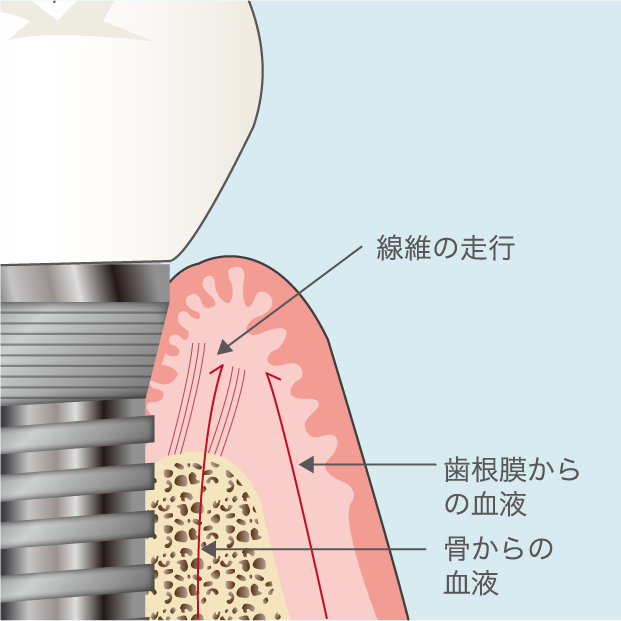 「インプラント周囲炎」が発症するリスク