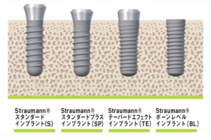 ストローマンのインプラント