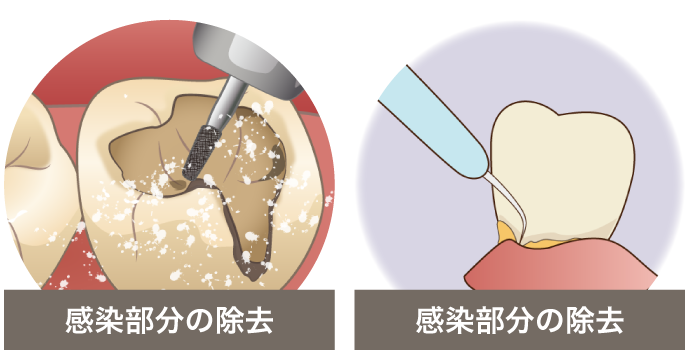 病気を治療する（感染除去）