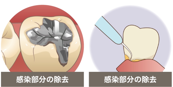 治療後（機能を補う）（維持・予防）