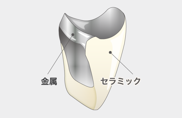 セラミックの歯