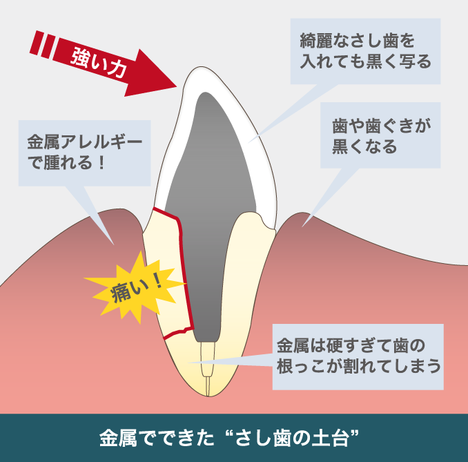 金属でできた“さし歯の土台”