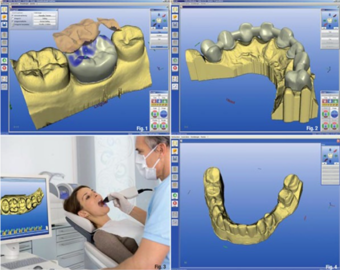 セレック（CEREC）を利用すると低価格で高品質