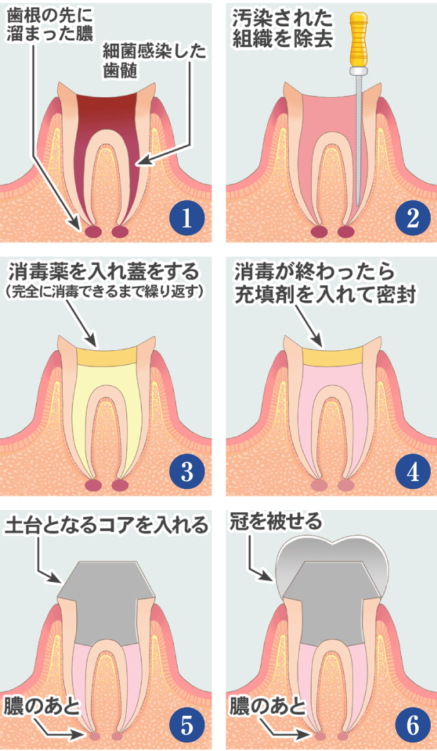 神経を取る場合の治療