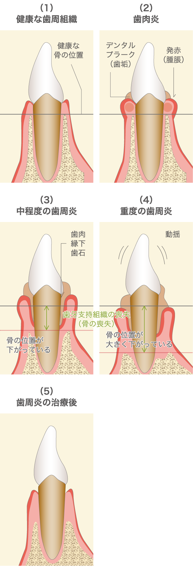 歯周病の治療は基本的に難しいものではありません