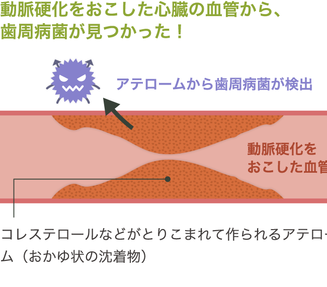 動脈硬化をおこした心臓の血管から、歯周病菌が見つかった！